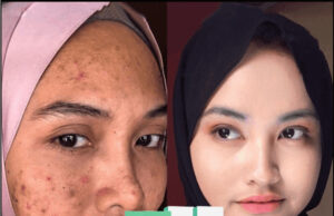 Khasiat dan Manfaat Acne Scar Remover Cream untuk Wajah Mulus